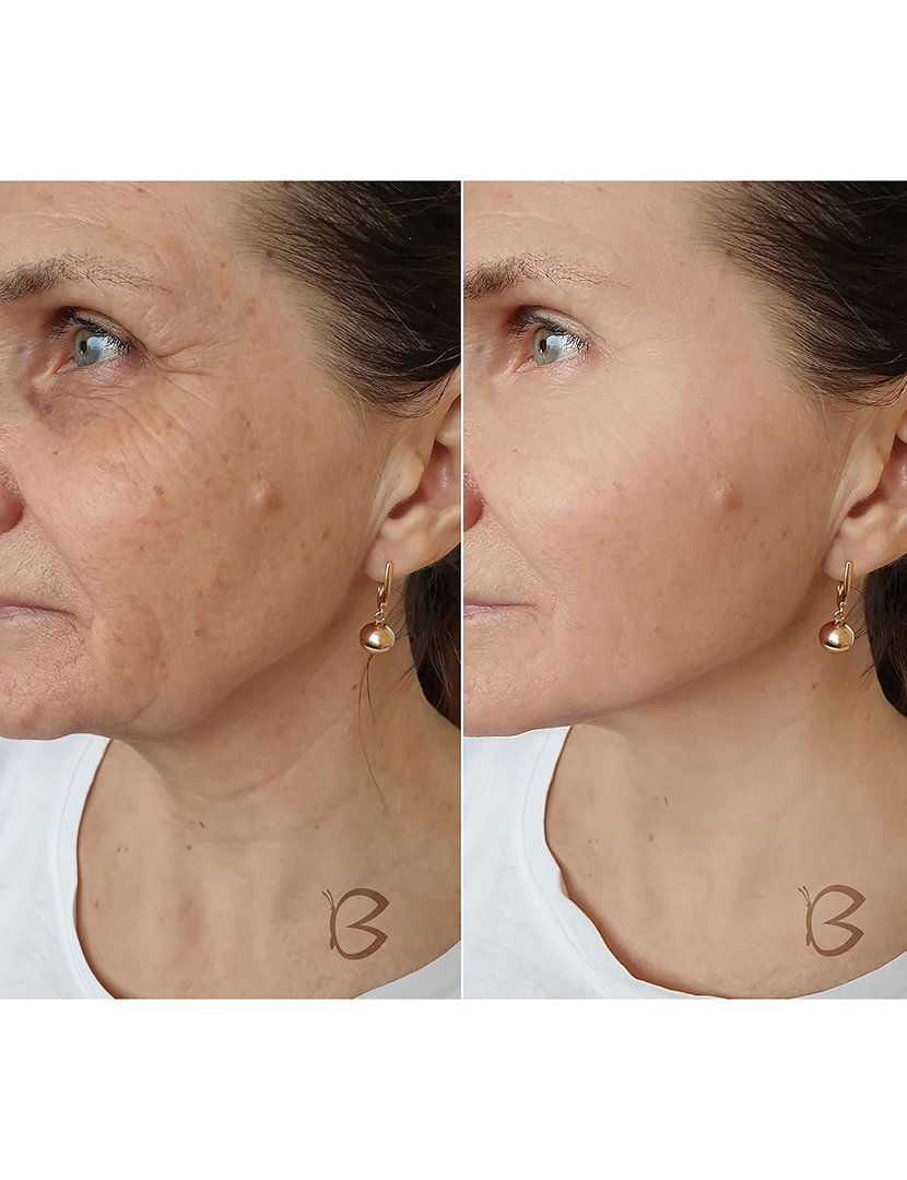 B-Meso Tecnologia de Microagulhamento